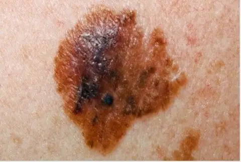 NHS Melanoma