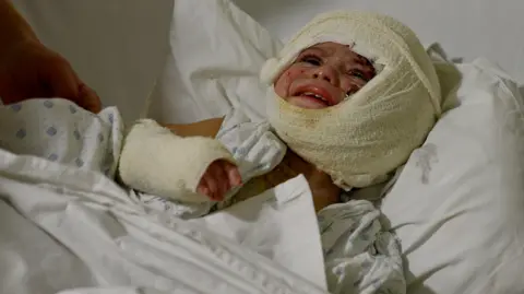 Goktay Koraltan/BBC A young child lies on a hospital bed, heavily bandaged around her head and face and hand