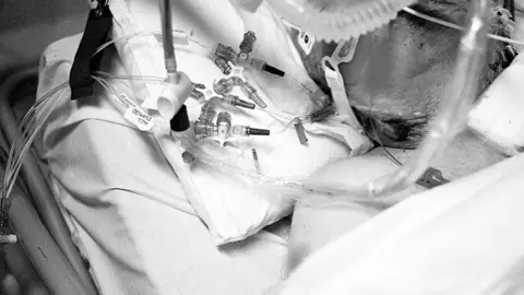 BBC A Covid-19 patient who has been dependent on a respirator for 23 days