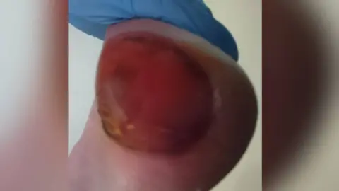 Kevin Collinson Mr Collinson's bedsore