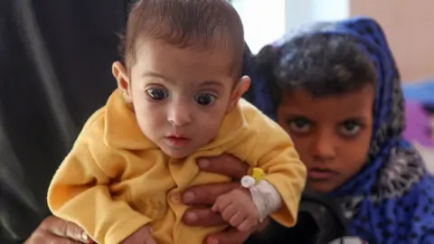 AFP A child suffering from malnutrition in war-ravaged Yemen, 21 November