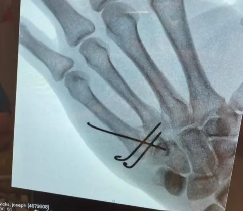 @thebodycoach X-ray of his hand