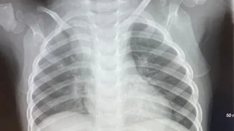 Michaela Stevens X-ray of Archie's chest showing partially collapsed lung