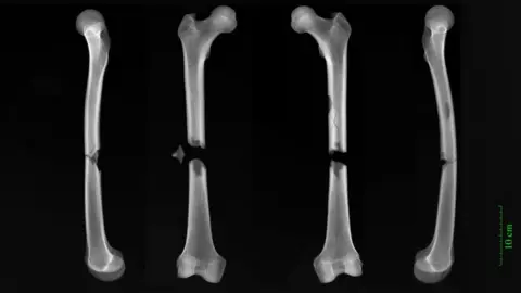 Dr Jenna Dittmar/PA Wire Fractures shown in X-ray