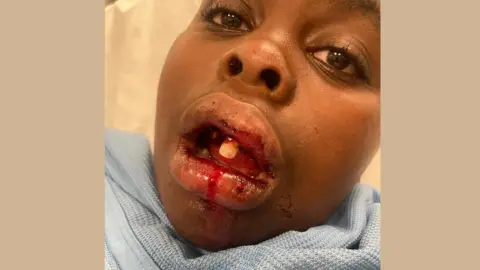 Stacey Noah missing his teeth