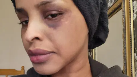 Niyad Farah with black eye