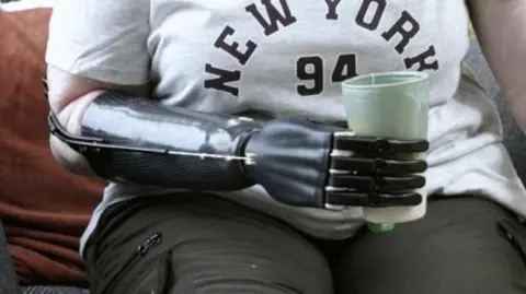 Metacarpal A woman wearing the prosthetic arm holding a cup.