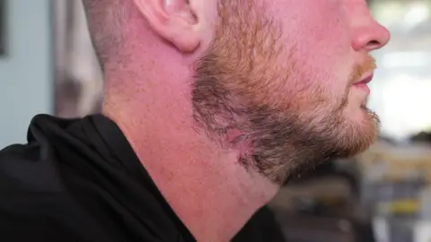 A pink scar can be seen on Geraint's neck, underneath his beard. Geraint is wearing a black t-shirt and is photographed from the side