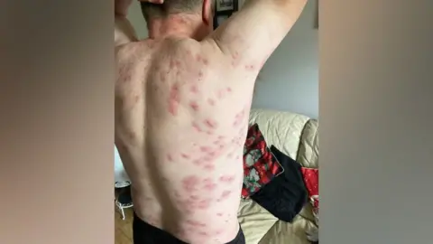 Andrew Powell Wasp stings on man's back