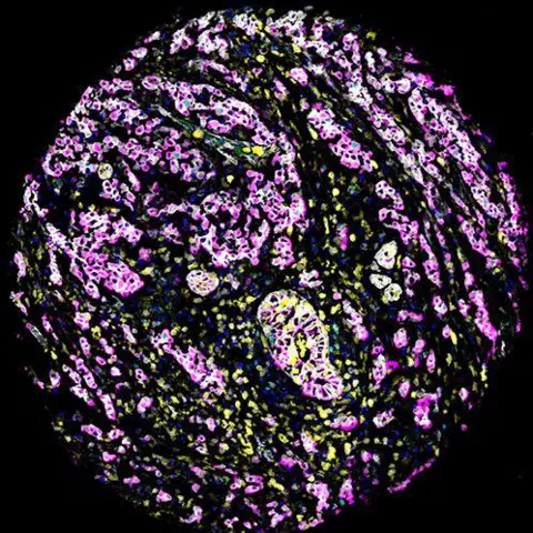 University of Southampton Microscope image of a breast cancer tissue sample. Different coloured stains highlight centrosomes (pink), epithelial cells (red, magenta, yellow and grey), blood vessels (green), dividing cells (cyan) and dying cells (turquoise). The blue stain shows the cell nuclei.
