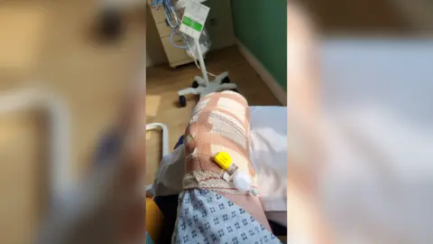 Charlie Price Charlie asked for his leg to be amputated