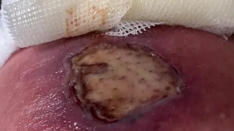 Sharon Portingale  Picture of the third degree burn beneath a bandage which has become infected with pus. 