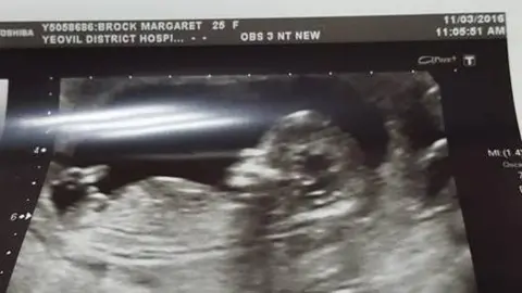 Maggie A photo of an ultrasound scan of Maggie's unborn son. The ultrasound was taken at Yeovil District Hospital.