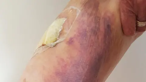 Amelia Borrelli Amelia's injured thigh