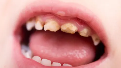 Getty Images Mushy teeth image