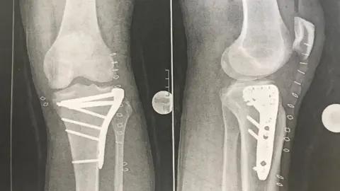 DRIVETRIBE.COM X-ray of Richard Hammond's leg