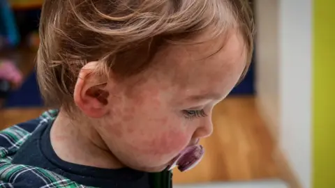 Stock photo of a child with a measles rash