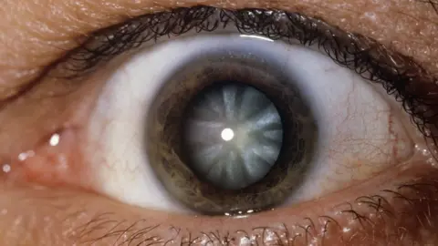 SCIENCE PHOTO LIBRARY Cataract