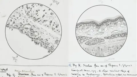 Wellcome Collection Anatomical drawings of the effect of influenza, from 1918