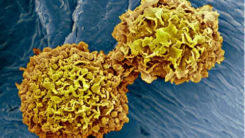 Science Photo Library breast cancer cells