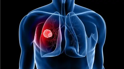 Getty Images Lung cancer