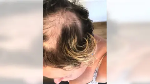 Kelda Griffiths hair missing from head