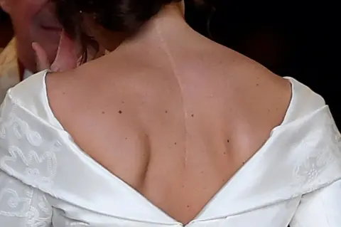 PA Princess Eugenie, with the scar from her surgery for scoliosis to treat a curvature of the spine