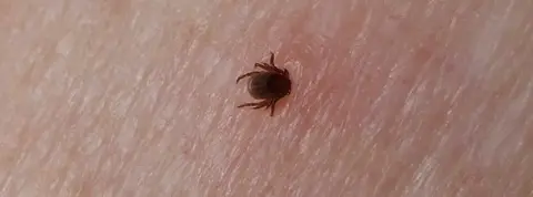 Lyme Disease Action Nymph attached to human