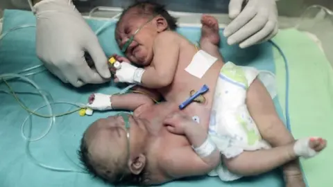 AFP Palestinian conjoined twins lie in an incubator at the nursery of the Shifa Hospital in Gaza City (02 October 2017)