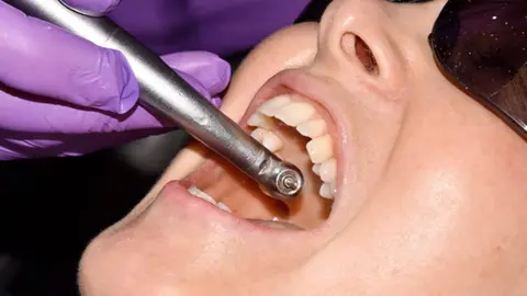 DR P. MARAZZI/SCIENCE PHOTO LIBRARY Dental filling