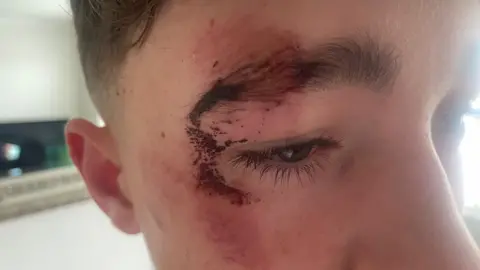 Family photo Oliver's injury to the crush at a school's gates showing a black eye and dried blood