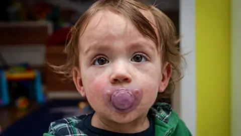 Getty Images Child with measles