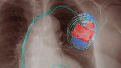 Getty Images pacemaker