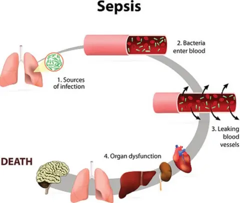Getty Images Sepsis