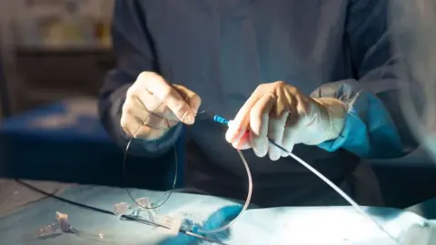 Getty Images Thrombectomy procedure