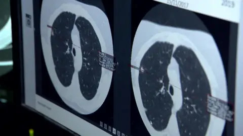 BBC News Lung cancer system