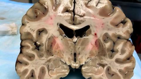 Aaron Hernández: el preocupante resultado de la autopsia del cerebro