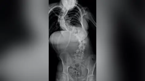 South Tees Hospitals NHS Foundation Trust X-ray of person with scoliosis