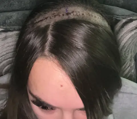 Paige Gouge scar on Paige's head