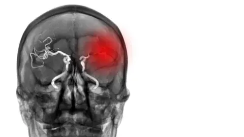 Getty Images Brain scan