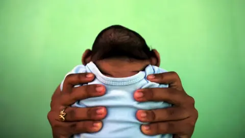 Reuters Baby with microcephaly