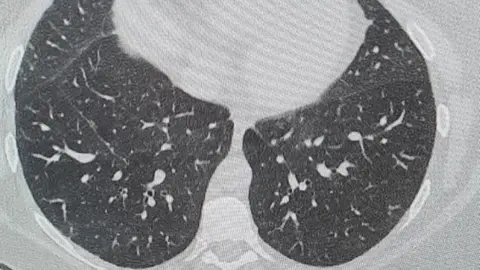 Handout Michelle's lungs before