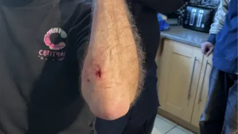 BBC Simon Edge's elbow