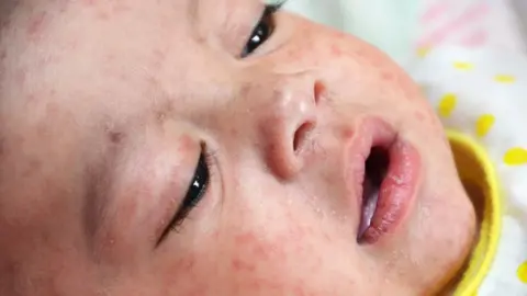 Science Photo Library Measles