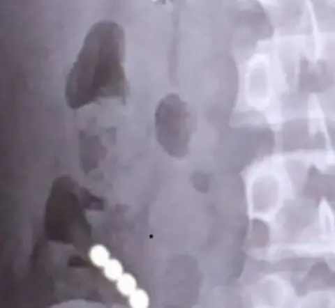 Cascadenews Freddie Webster's X-ray