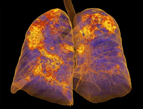 SPL Lungs infected with coronavirus