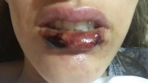 Save Face woman with infection in lip after filler