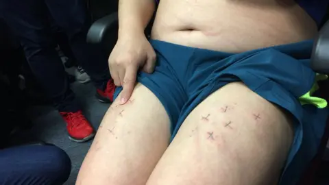 Howard Lam shows crosses made from metal staples in his legs