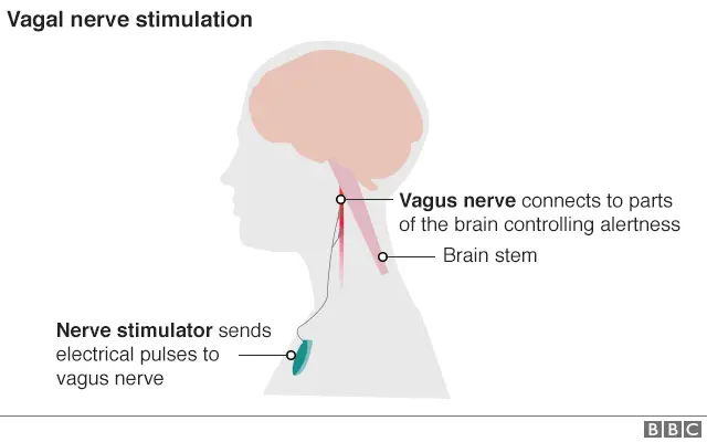 Graphic showing how electrical impulses are sent to vagus nerve