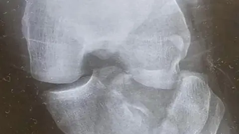 Handout X-ray of broken bone